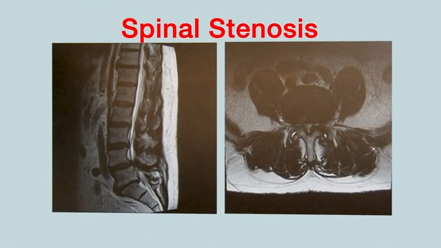 Lumbar Spinal Stenosis - OrthoInfo - AAOS