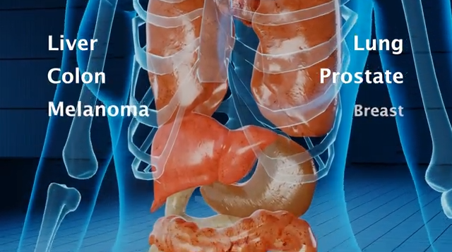 Histotripsy: Liquifying Liver Tumors